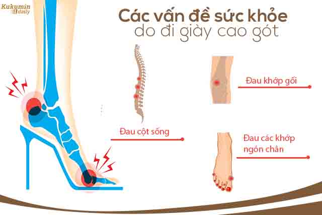 thường xuyên đi gày cao gót dẫn tới thoái hóa khớp xương: cột sống, ngón chân, đầu gối